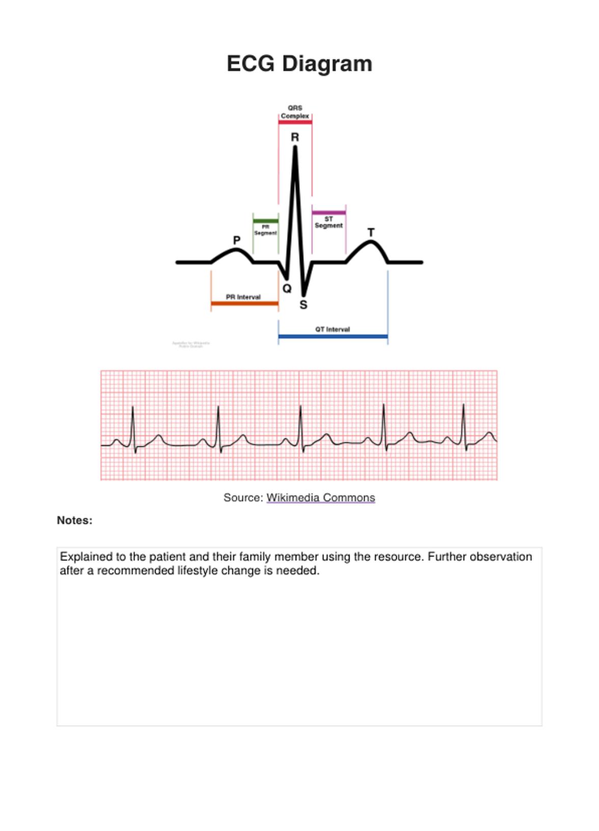 ECG Diagram PDF Example