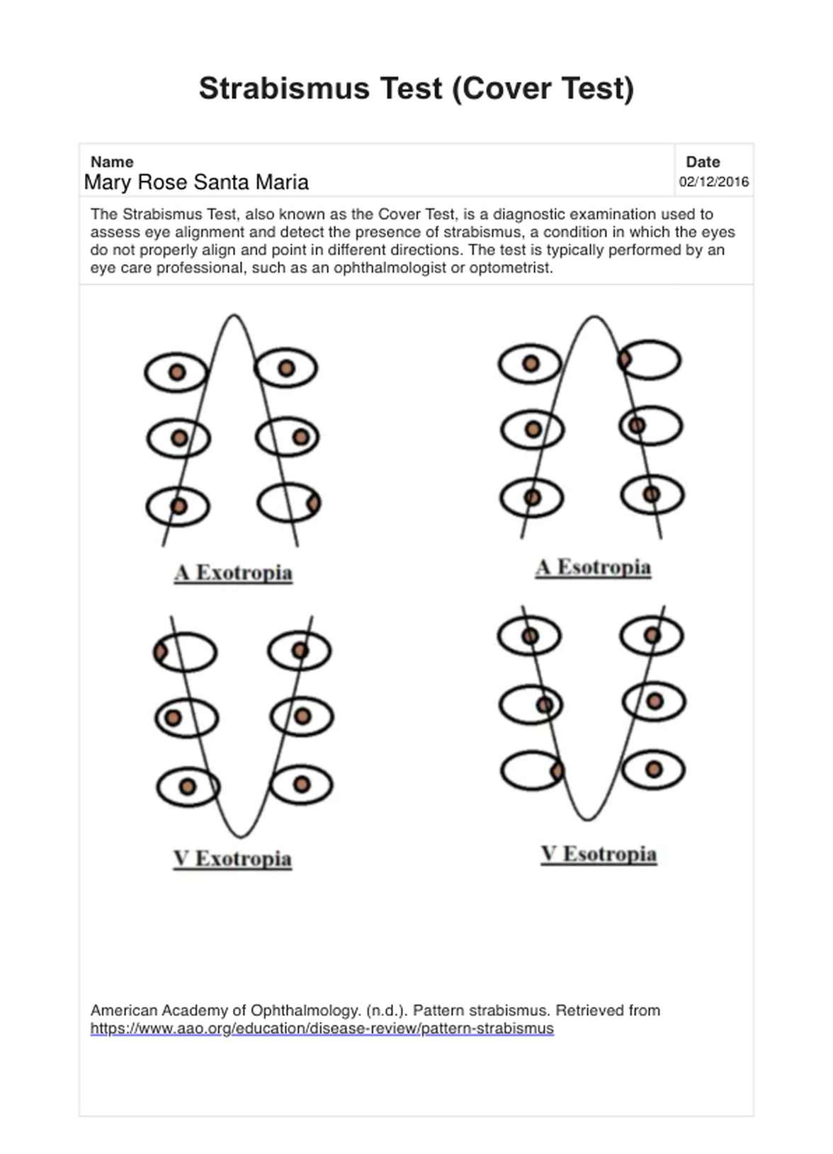 Strabismus Test & Example | Free PDF Download